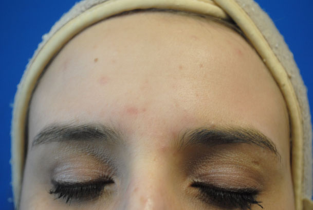 la nouvelle10 chemical peel medical spa oxnard forehead 
